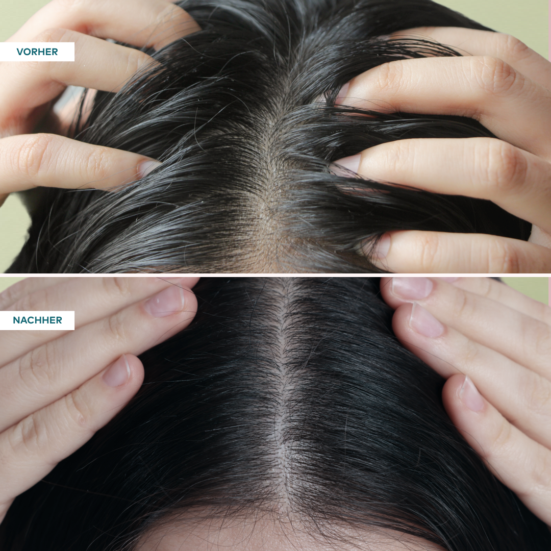Scalp Care Set